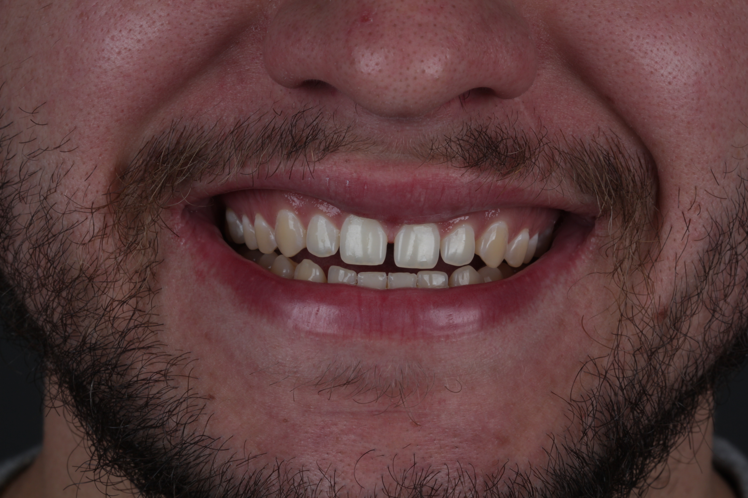 Antes de lentes de contato dental